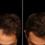 Hair Transplantation Before and After Photos in Cincinnati, OH, Patient 19919