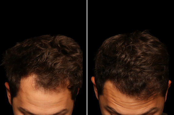 Hair Transplantation Before and After Photos in Cincinnati, OH, Patient 19919
