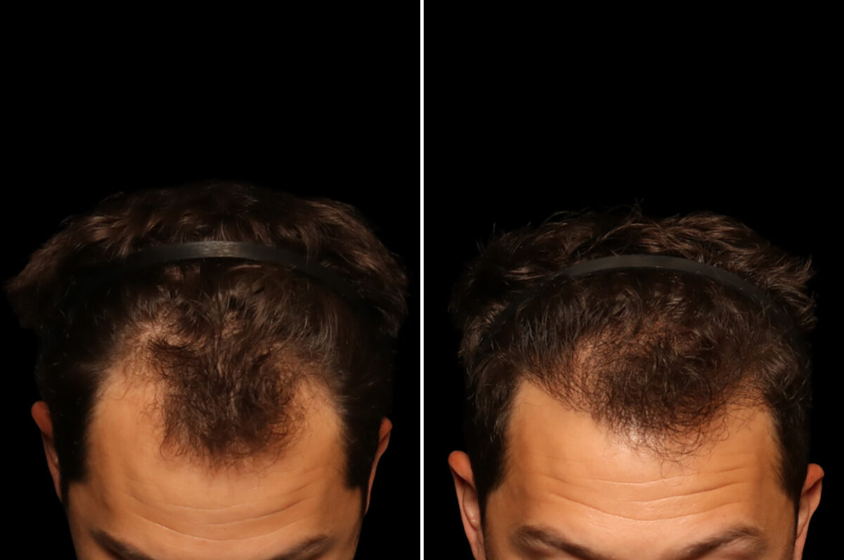 Hair Transplantation Before and After Photos in Cincinnati, OH, Patient 19919