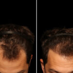Hair Transplantation Before and After Photos in Cincinnati, OH, Patient 19919