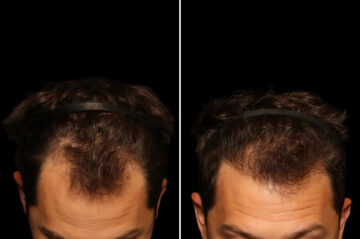 Hair Transplantation Before and After Photos in Cincinnati, OH, Patient 19919